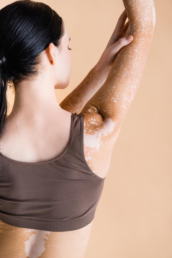 vissza kilátás fiatal gyönyörű nő vitiligo pózol elszigetelt bézs - Fotó, kép