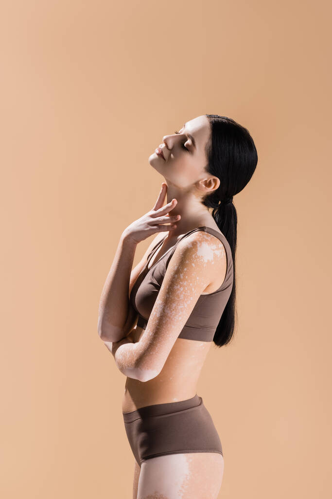 vista lateral de joven hermosa mujer con vitiligo posando aislado en beige - Foto, Imagen
