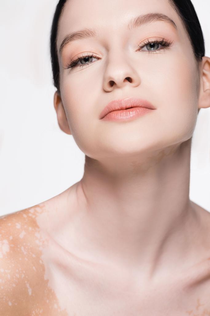 portrait of young beautiful woman with vitiligo isolated on white - Photo, Image
