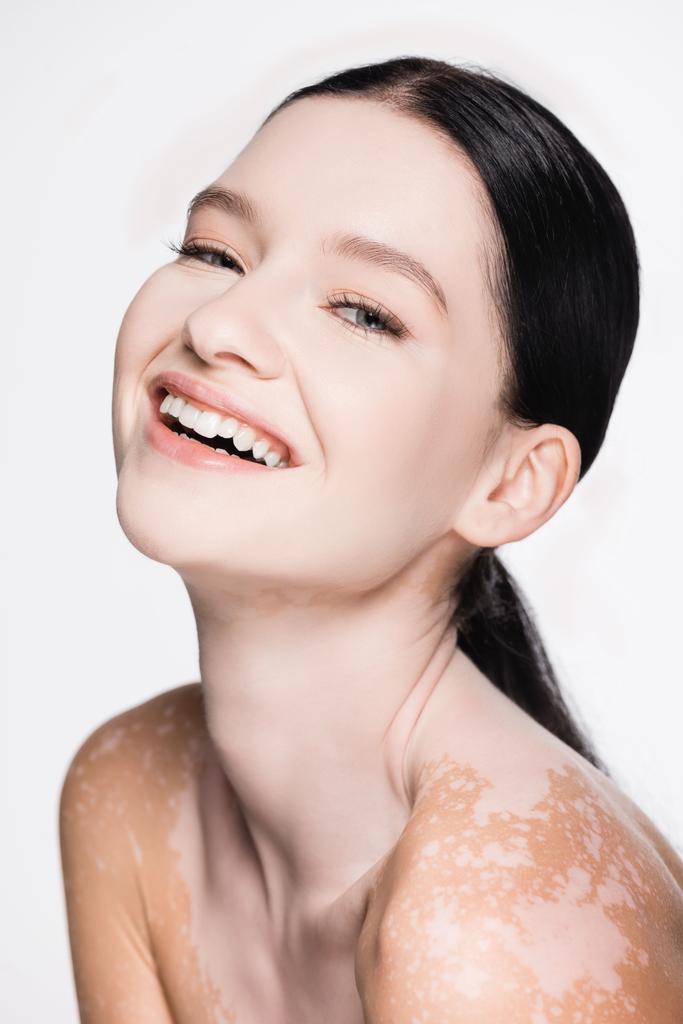 usmívající se mladá krásná žena s vitiligem izolované na bílém - Fotografie, Obrázek