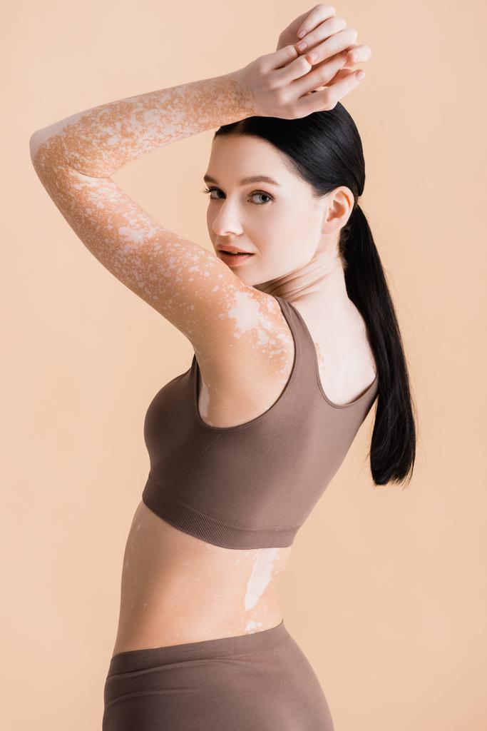 mladá krásná žena s vitiligo pózování ve spodním prádle izolované na béžové - Fotografie, Obrázek