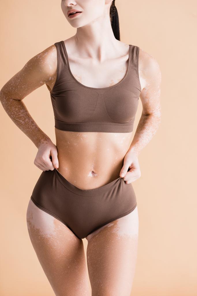 recortado vista de joven hermosa mujer con vitiligo posando en ropa interior aislado en beige - Foto, imagen