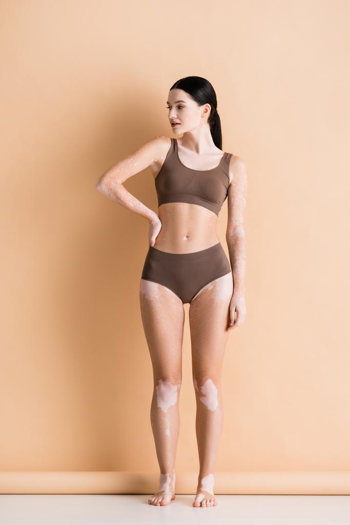 young beautiful woman with vitiligo posing in underwear on beige - Photo, Image