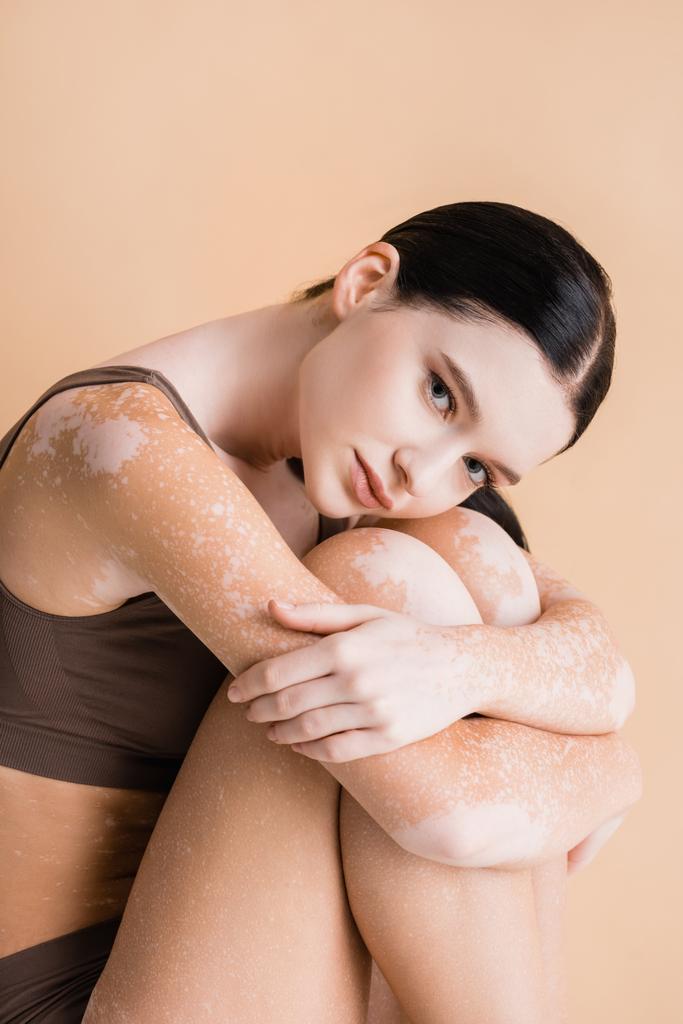 young beautiful woman with vitiligo isolated on beige - Photo, Image