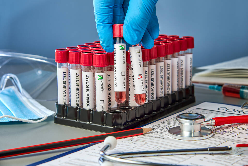 Test tubes in the doctor's hand with a positive and negative blood sample for COVID-19. Blood testing for the presence of antibodies to the causative agent of a new coronavirus infection - Foto, afbeelding