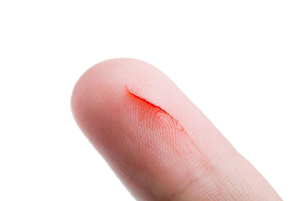 human finger with a cut a consequence of skin damage and open bleeding from a scratch on the patient body close-up isolated on a white background. - Foto, immagini