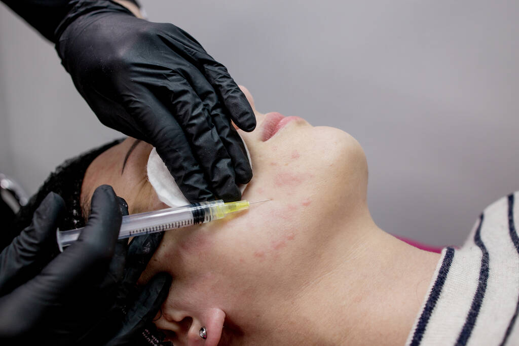 Lekarz kosmetolog wykonuje wielokrotne zastrzyki biorewitalizacji kwasem hialuronowym w skórze twarzy kobiety, zbliżenie. Kobieta w trakcie zabiegu wstrzyknięcia mezoterapii. - Zdjęcie, obraz