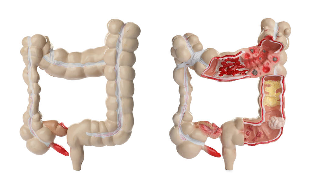 Modelo anatômico do intestino grosso sobre fundo branco, colagem. Gastroenterologia - Foto, Imagem