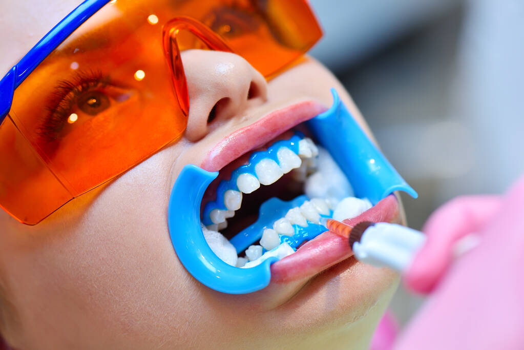 El dentista aplica gel a los dientes antes del procedimiento de blanqueamiento dental. Hermosa chica con gafas de seguridad. Dental y blanqueamiento dental Concepto. - Foto, Imagen
