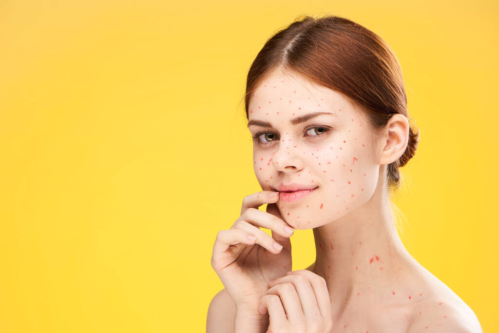 Frau mit nackten Schultern rote Punkte im Gesicht Gesundheitsprobleme Dermatologie - Foto, Bild