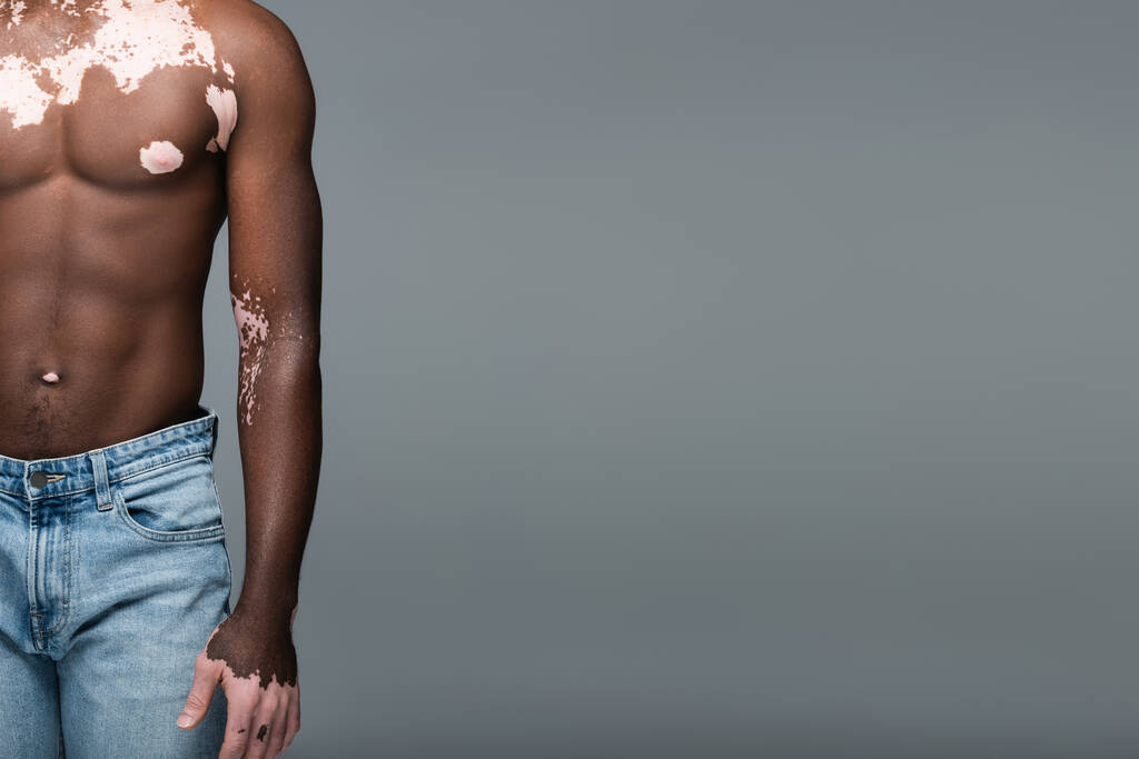vista recortada de hombre afroamericano sin camisa con piel de vitiligo de pie en jeans aislados en gris - Foto, Imagen
