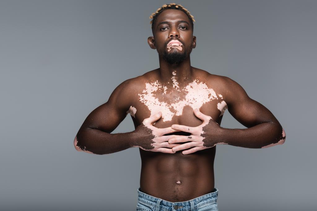 muscular african american man with vitiligo standing with hands on chest and looking at camera isolated on grey - Foto, afbeelding