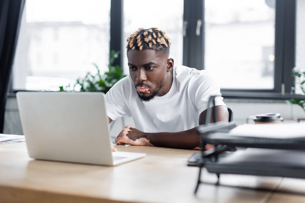 hombre afroamericano concentrado con vitiligo trabajando en el ordenador portátil en la oficina - Foto, imagen