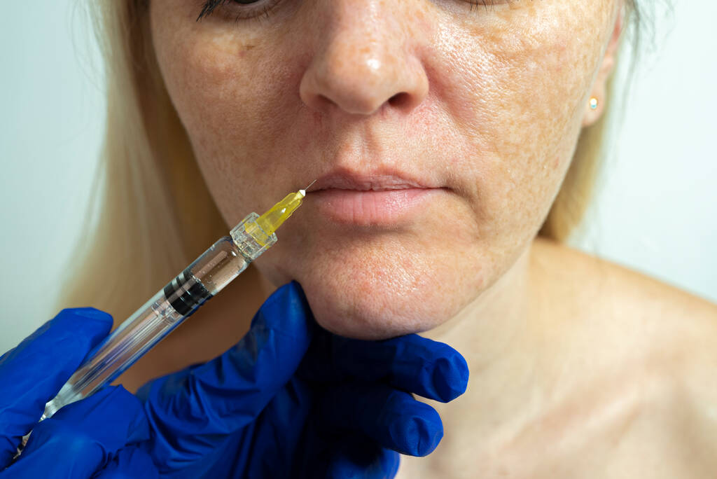 美容クリニックで針療法。化粧品は女性の顔に注入されます. - 写真・画像