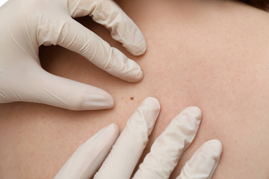 Dermatologista em luvas examinando marca de nascença do paciente, vista de perto - Foto, Imagem