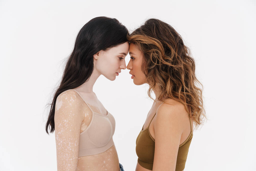Dvě mladá žena ve spodním prádle stojí spolu objímající izolované přes bílé pozadí vitiligo kůže koncept - Fotografie, Obrázek