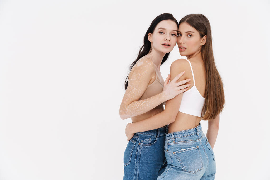 Две молодые женщины в нижнем белье стоят вместе обнимая изолированные на белом фоне витилиго концепции кожи - Фото, изображение