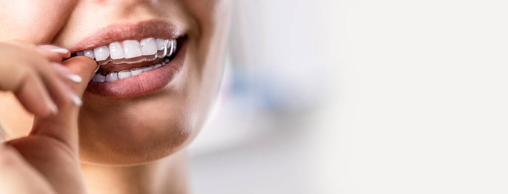 Жінка інопланетянин одягає невидимі силіконові зуби. Стоматологічні брекети для корекції зубів
. - Фото, зображення