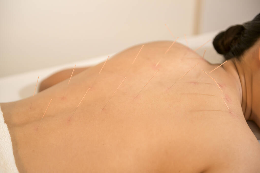 Beautiful Woman Received acupuncture treatment on back by  therapist, chinese medicine treatment, health and healing concept. - Photo, Image