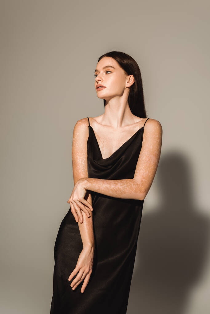 Gri arka planda siyah elbiseli, vitiligolu güzel bir genç kadın.  - Fotoğraf, Görsel
