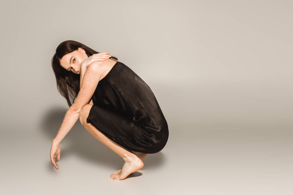 босоніжка модель з вітіліго позує в сукні на сірому фоні з тіні
  - Фото, зображення