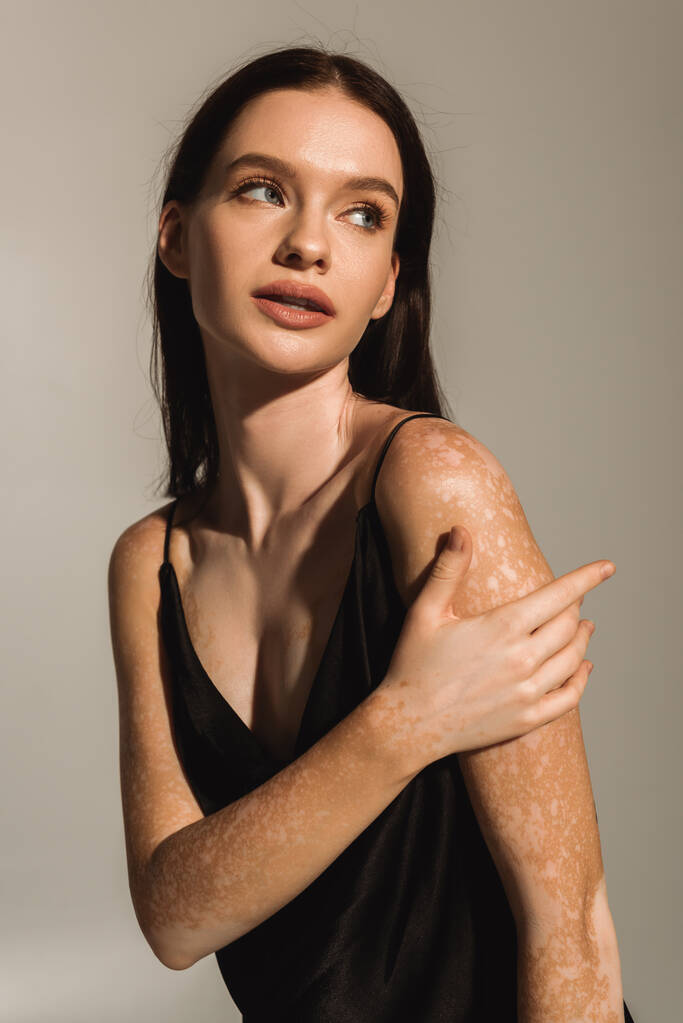 Porträt der hübschen Frau mit Vitiligo berühren Schulter isoliert auf grau mit Licht  - Foto, Bild