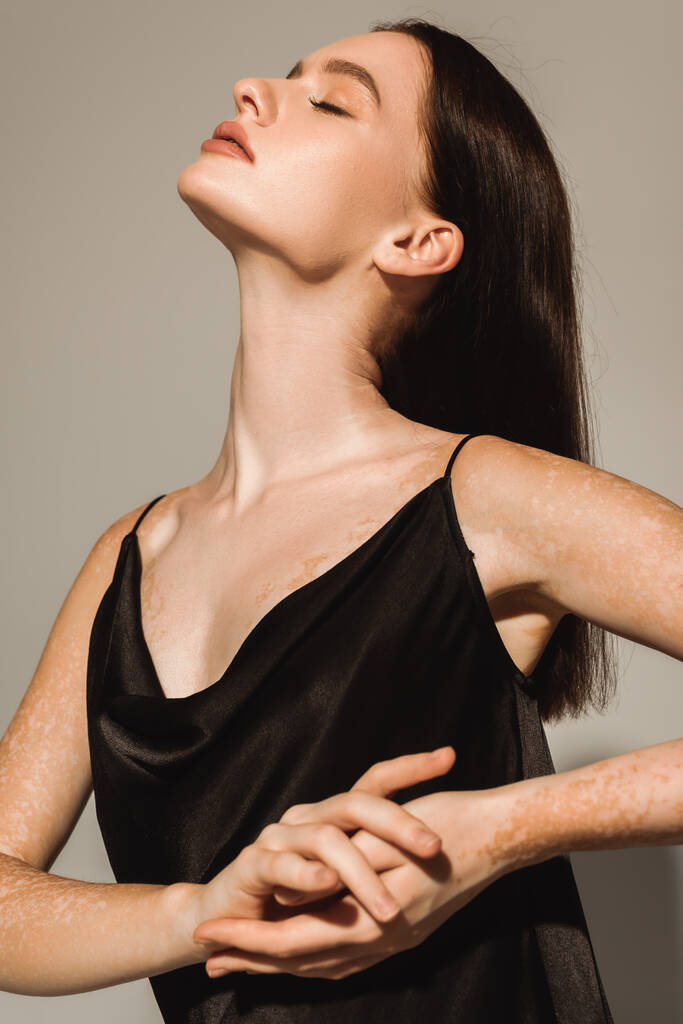 Bonita modelo con vitiligo posando en vestido de seda sobre fondo gris  - Foto, Imagen