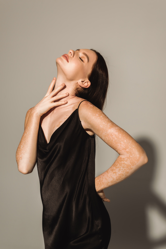 Trendy fiatal nő vitiligo érintő nyak szürke háttér  - Fotó, kép