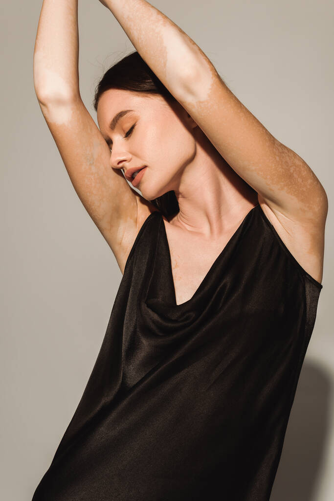 Modelo sensual com vitiligo posando em vestido preto sobre fundo cinza  - Foto, Imagem