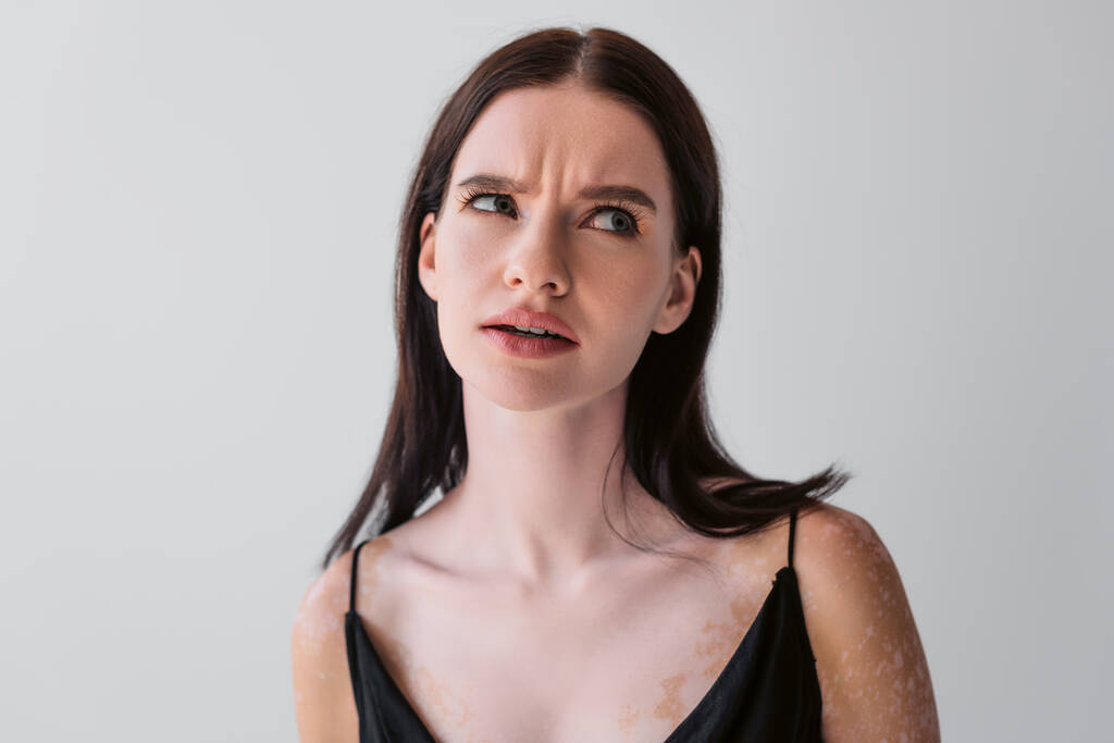 Zamyšlená žena s vitiligem odvrací pohled na šedé  - Fotografie, Obrázek