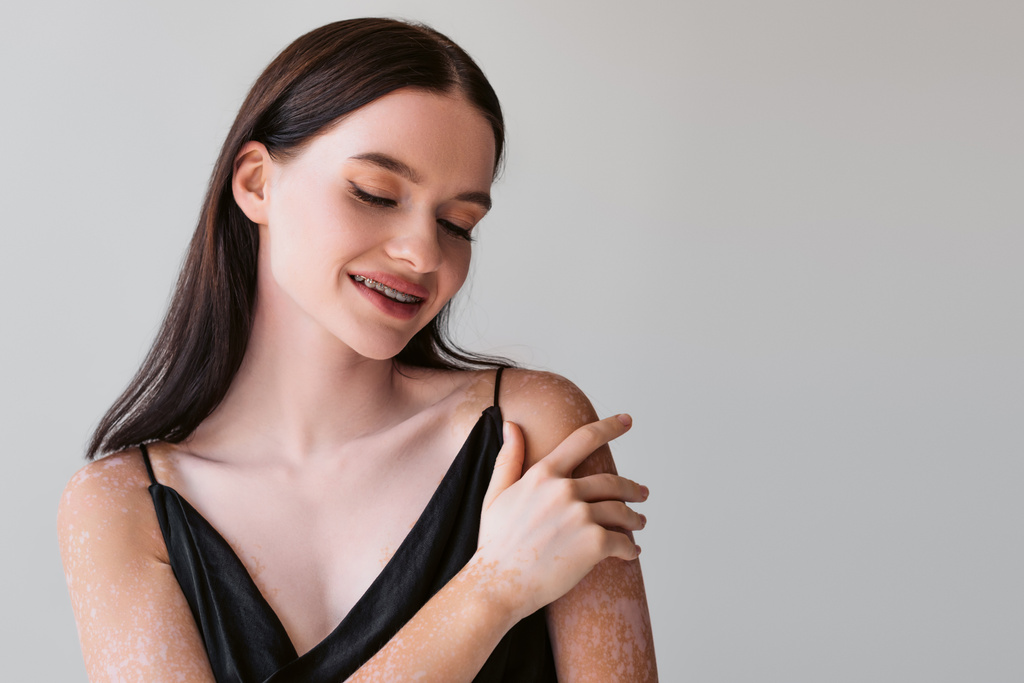 Hezká mladá žena s vitiligem a rovnátka dotýkající se ramene a usmívající se izolované na šedé  - Fotografie, Obrázek