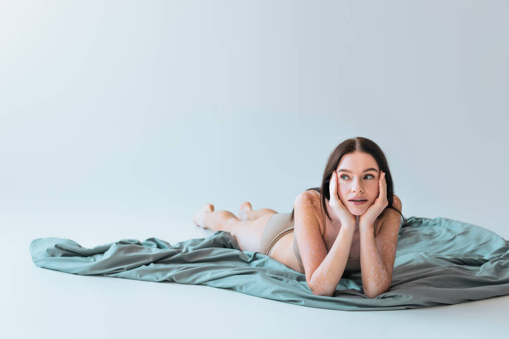 junge brünette Frau mit Vitiligo chronische Hauterkrankung liegt auf Decke auf grauem Hintergrund  - Foto, Bild