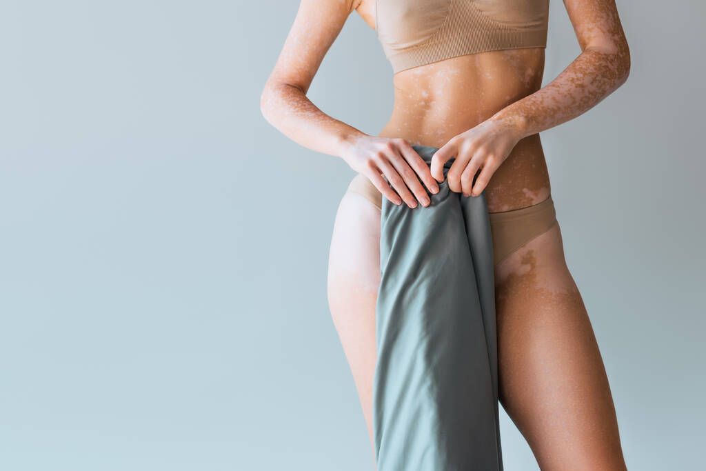 обрезанный вид женщины с заболеванием кожи витилиго проведение одеяло на сером фоне  - Фото, изображение