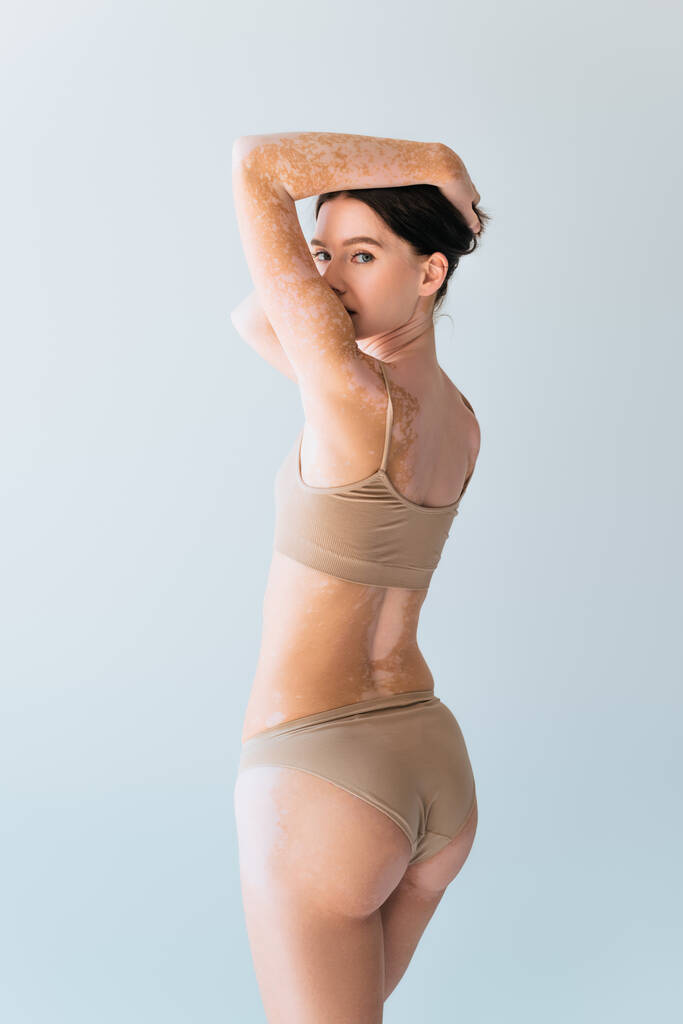 young woman with vitiligo standing in beige lingerie and looking at camera isolated on grey - Photo, Image