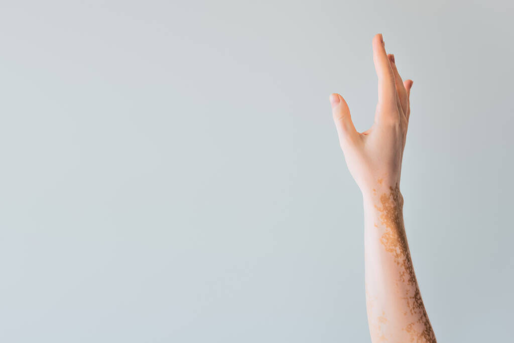vista recortada de elegante mano femenina con vitiligo aislado en gris - Foto, imagen
