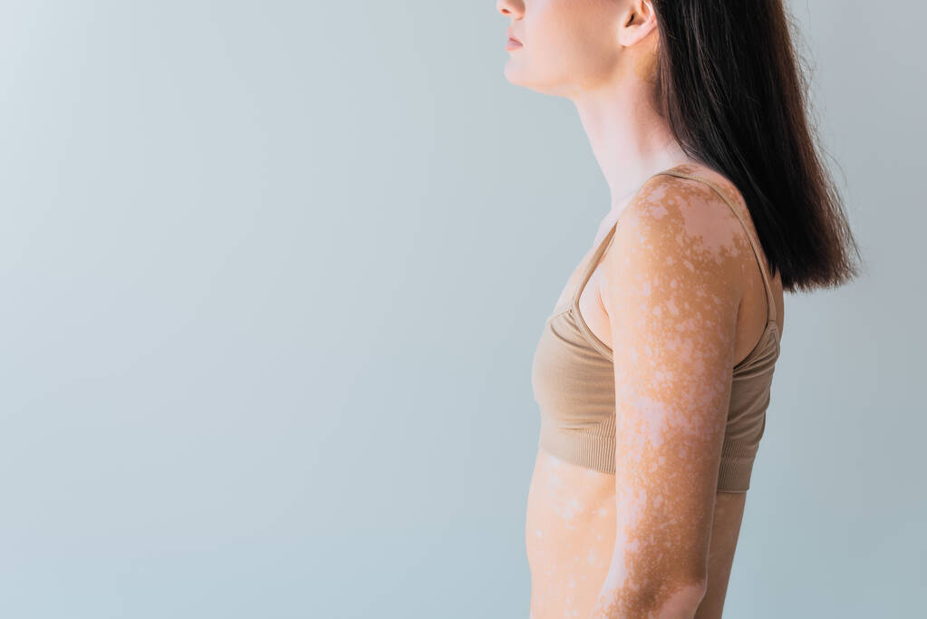 recortado vista de morena joven con vitiligo de pie aislado en gris - Foto, Imagen