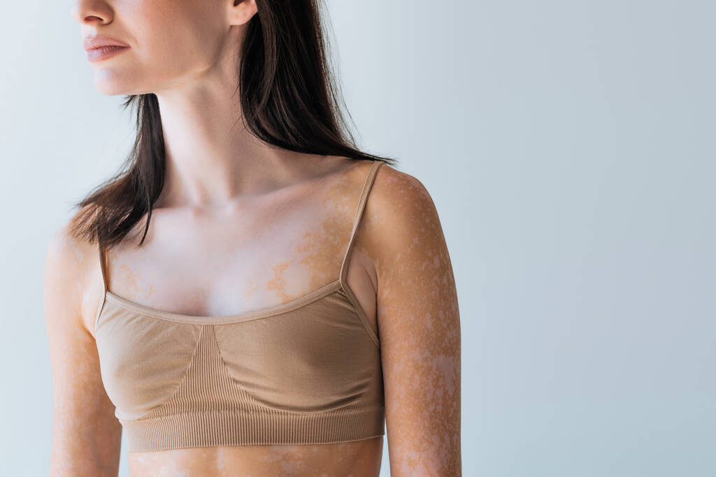 osittainen näkymä brunette nuori nainen vitiligo seisoo eristetty harmaa - Valokuva, kuva