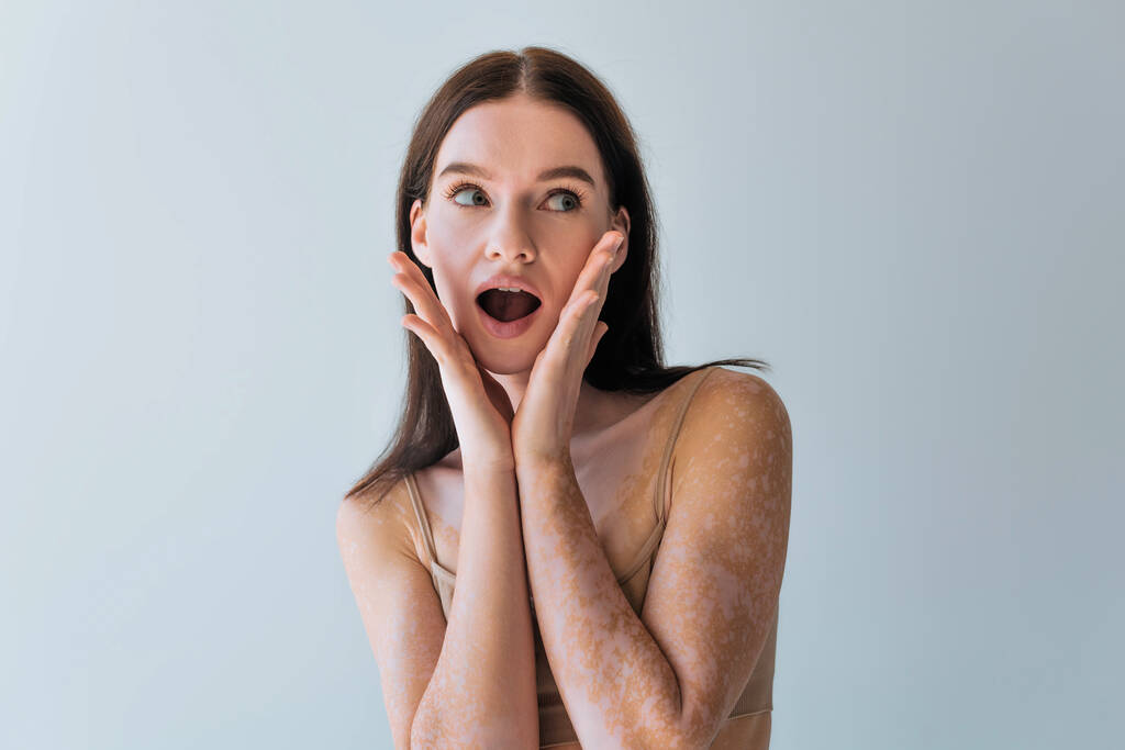 mujer joven asombrada con vitiligo mirando hacia otro lado aislado en gris - Foto, Imagen