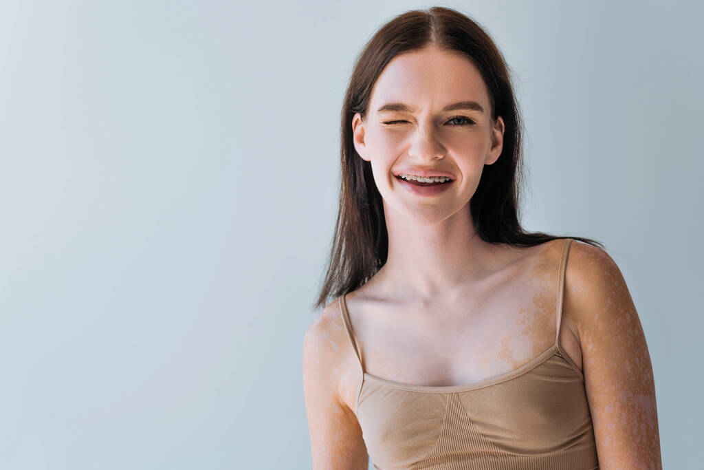 happy young woman with vitiligo and braces winking isolated on grey - Photo, Image