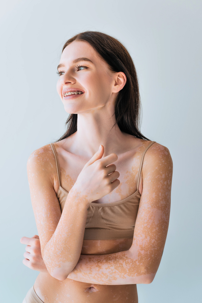 pozitivní mladá žena s vitiligem a rovnátka s úsměvem izolované na šedé - Fotografie, Obrázek