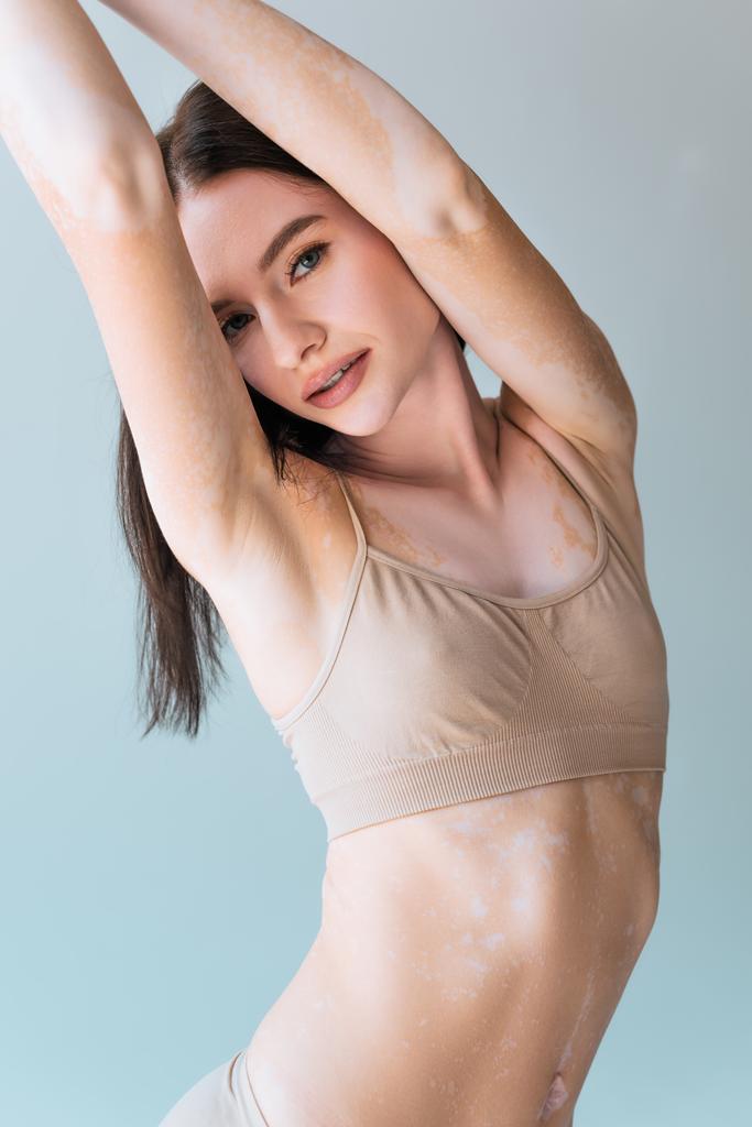 young woman with vitiligo posing with raised hands and looking at camera isolated on grey - Photo, Image
