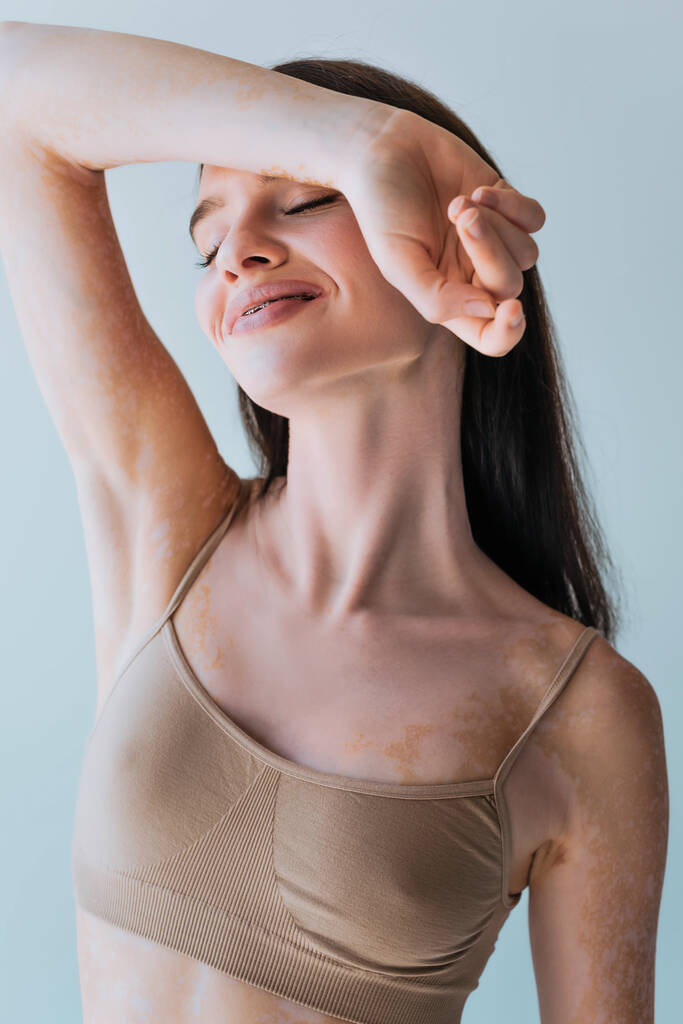retrato de mujer joven y contenta con vitiligo y ojos cerrados posando aislados sobre gris - Foto, imagen