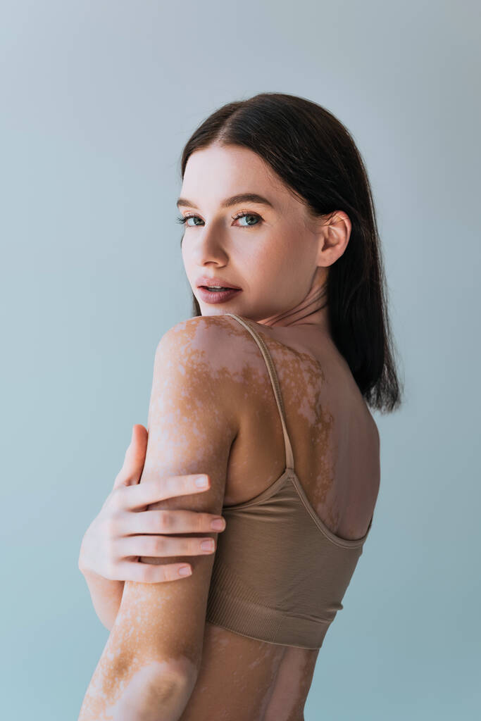 retrato de jovem morena com vitiligo olhando para câmera isolada em cinza - Foto, Imagem