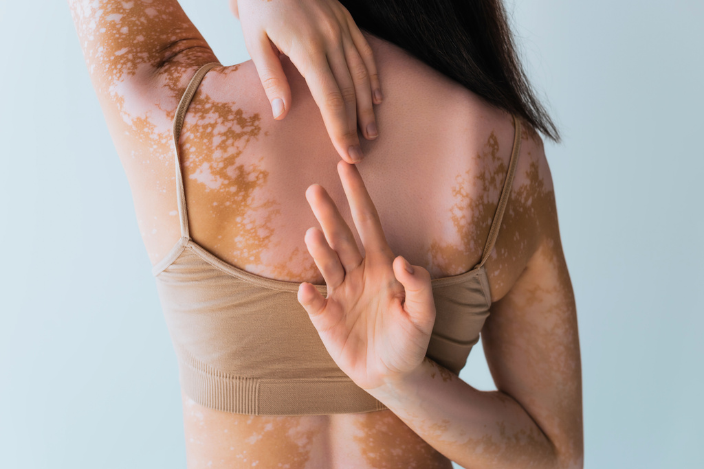 Vitiligo 'lu esmer kadının arkadan görünüşü parmaklarını birbirine değdirmesi gri renkte izole edilmiş.  - Fotoğraf, Görsel