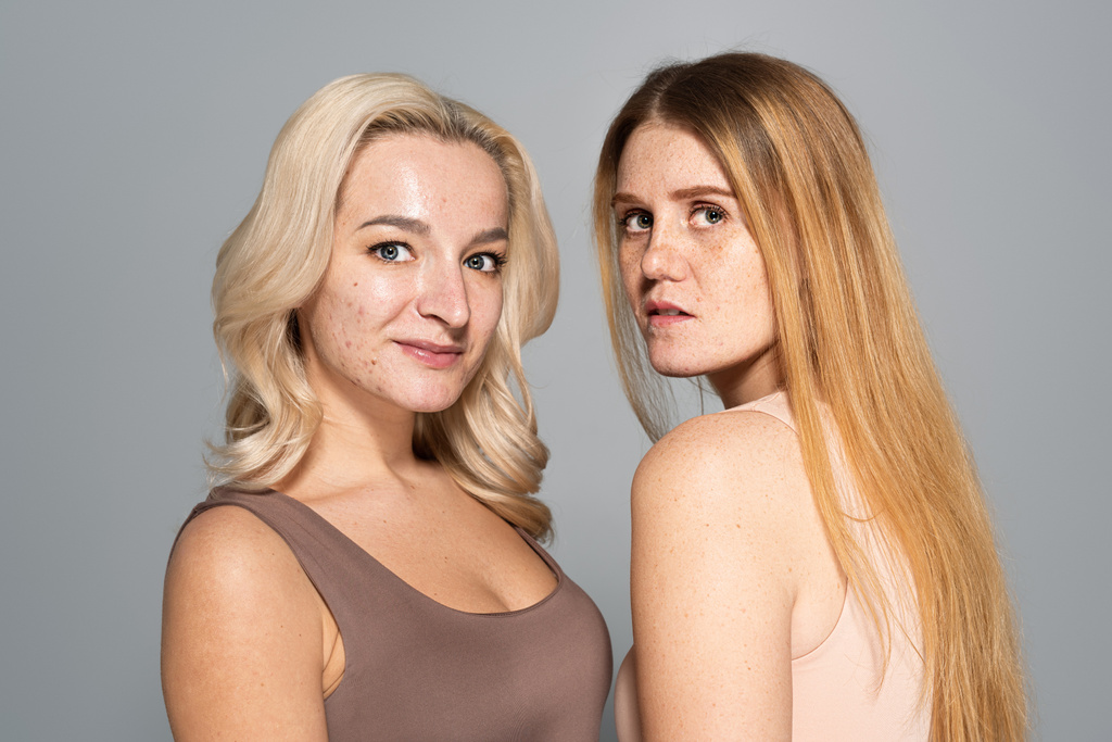 Jonge vrouwen met sproeten en acne op zoek naar camera geïsoleerd op grijs  - Foto, afbeelding