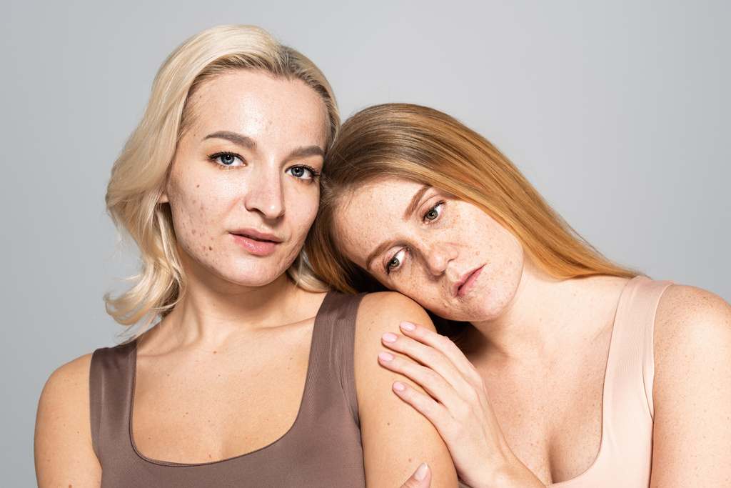 Zdenerwowana kobieta z piegowatą skórą opierająca się na ramieniu przyjaciela z trądzikiem wyizolowanym na szaro  - Zdjęcie, obraz