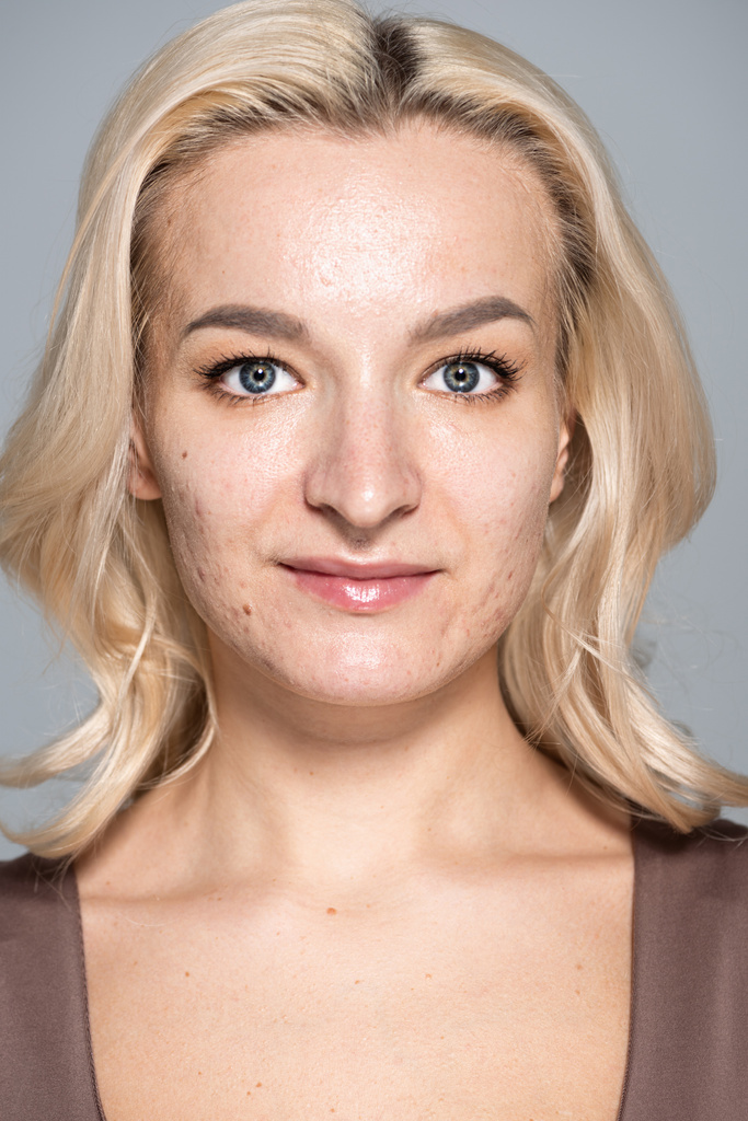 Ritratto di donna bionda con acne sul viso guardando la macchina fotografica isolata sul grigio  - Foto, immagini
