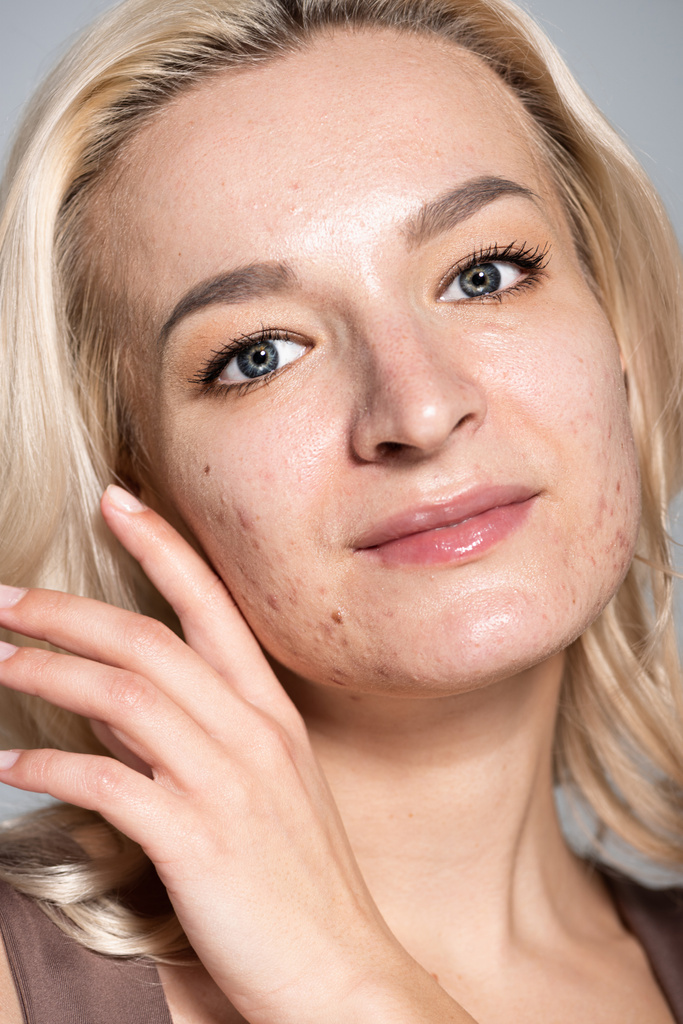 Close up view of blonde woman with acne on skin isolated on grey  - Photo, Image
