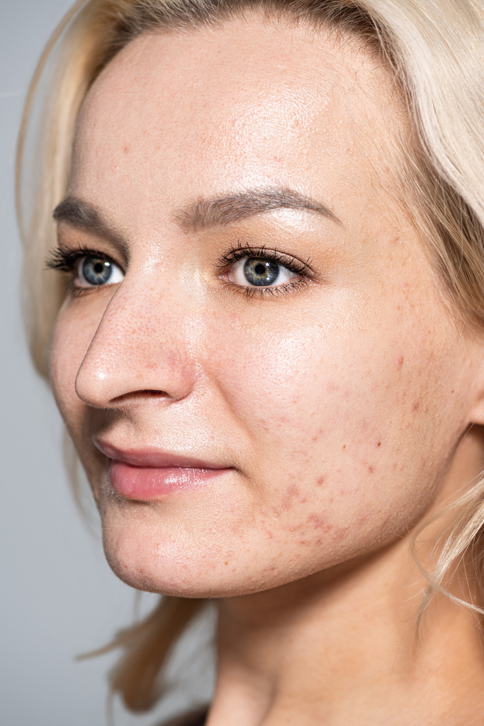Zblízka pohled na ženu s akné na kůži dívá pryč izolované na šedé  - Fotografie, Obrázek