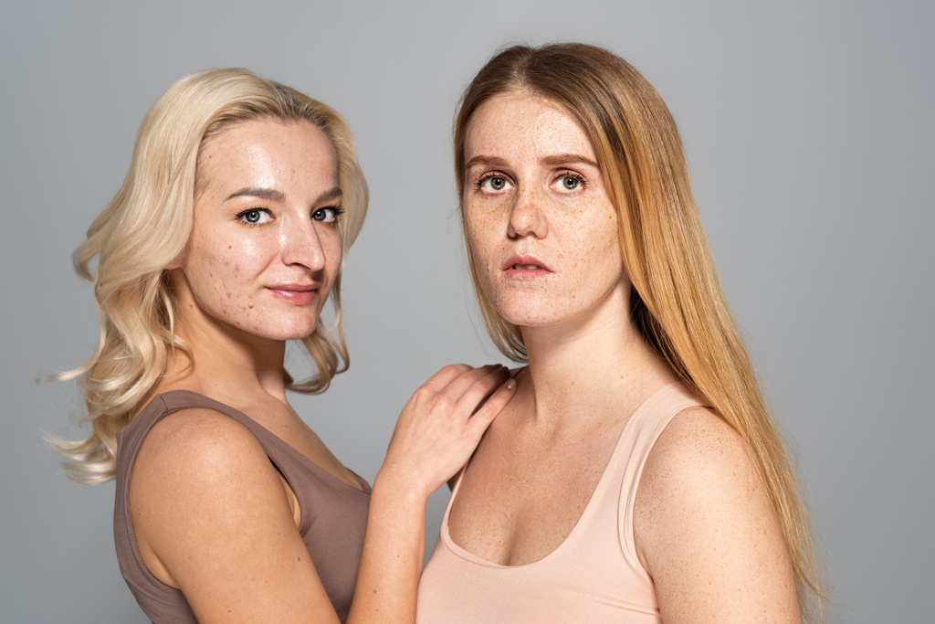 Smiling woman with acne on face standing near model with freckles isolated on grey  - Photo, Image